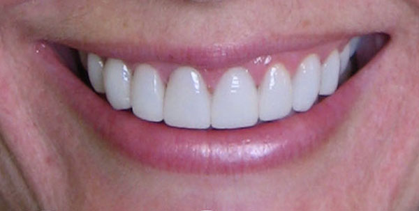 Case 2 — Full Smile Makeover — after